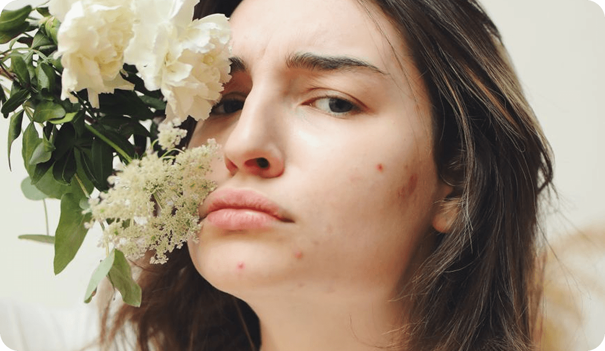 What actually causes adult acne